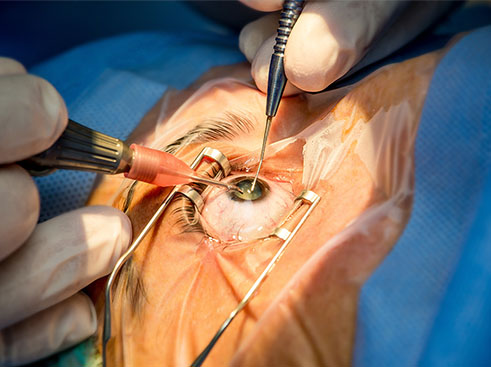 Management of Vitreous Loss in Cataract Surgery