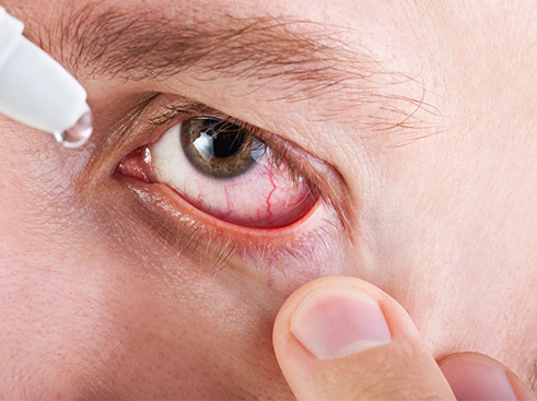 Diagnosis and Management of Dry Eye Syndrome
