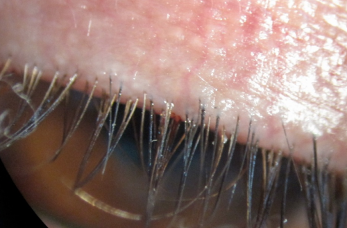 Blepharitis with crusted eyelashes